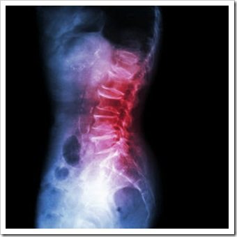 Back Pain Spokane WA Arthritis