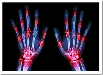Rheumatoid Arthritis Solutions Spokane WA