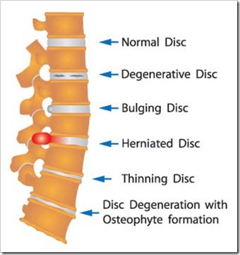 Back Pain Spokane WA Arthritis